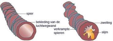 Waarom heb je last van astma?