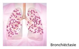 bronchiectasieen