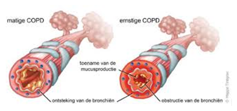 copd-2