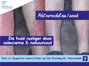 Zoutkamer Veenendaal helpt met solecreme en natuurzoutoplossing in korte tijd eczeem tegen gaan