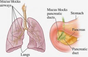 Medicijnvrije Behandeling van Cystic fibrose of taaislijmziekte